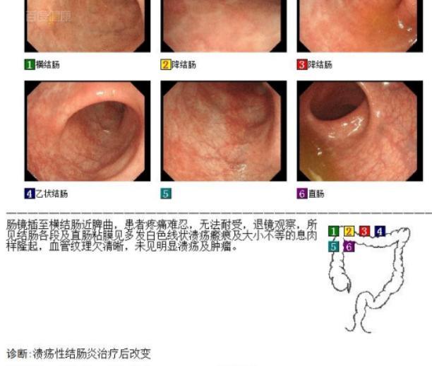 最新溃结治疗方法的研究与应用进展